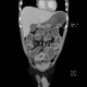 Crohn's disease of small bowel, abdominal abscess, CT enterography: CT - Computed tomography